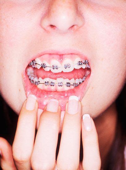 Why This Diy Braces Trend Is Really Dangerous Diy Braces Fake Braces Diy Fake Braces