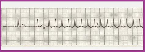 Na diferenciálnu diagnostiku svt sa používajú diagnostické algoritmy. Float Nurse: Practice EKG Rhythm Strips 217