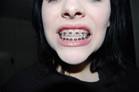 BRO's Lifestyle Guide to Adult Braces | BRO Blog