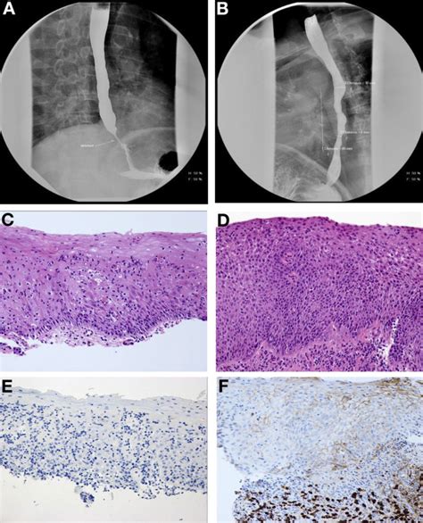 Occurrence Of Igg In Esophageal Lichen Planus Clinical