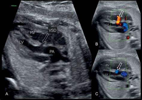 Fetal Vsd Ultrasound