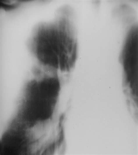 Spectrum Of Pulmonary Aspergillosis Histologic Clinical And