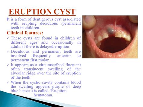 Dentigerous Cyst Clinical Features