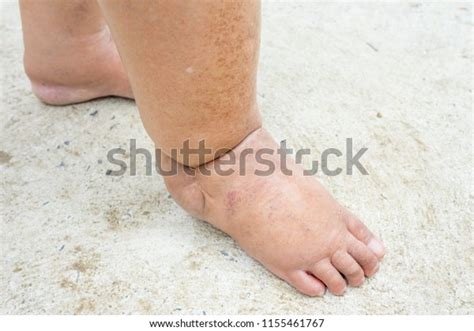 Feet People Diabetes Dull Swollen Due Stock Photo 1155461767 Shutterstock