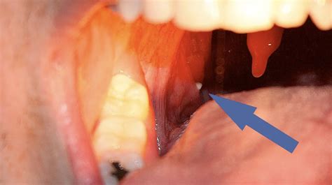 Tackling Tonsil Troubles The Lowdown On Tonsil Stone Removal Tools
