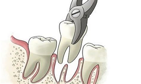 Estrazione Dentaria Ecco Quando E Come Farsi Togliere Un Dente