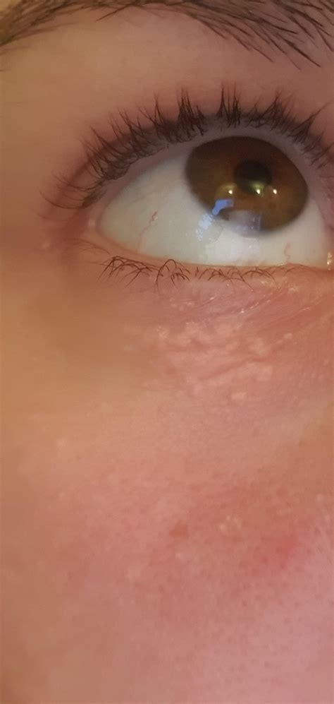 Skin Concerns Ive Had These Lumps Under My Eyes Since I Can Remember