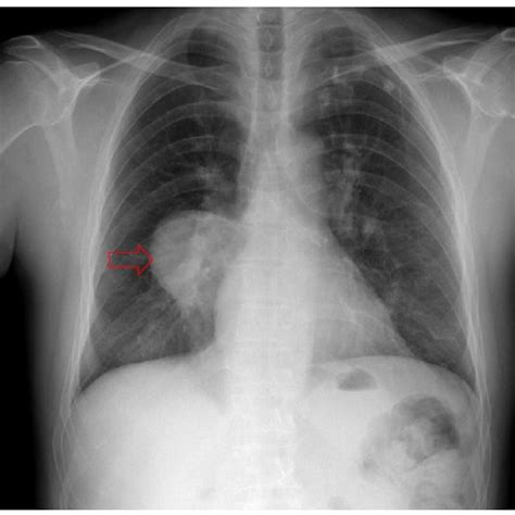 Posteroanterior And Lateral Chest X Rays Showing Lung Cysts A Big