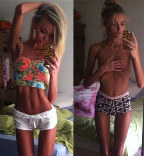 Former Anorexic Transforms Into Inspiring Teen Beauty Queen Pics Izismile