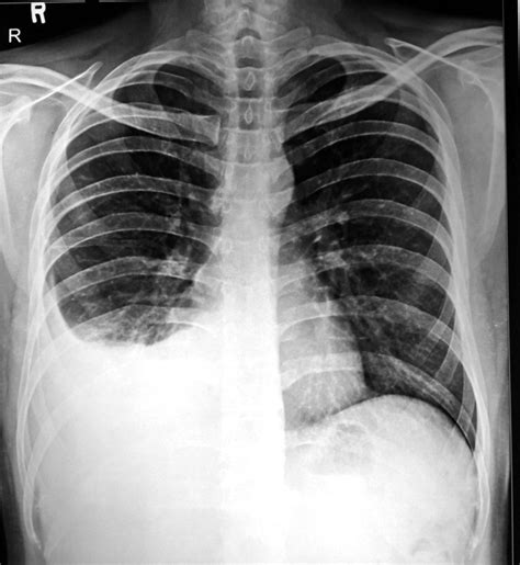 Paradoxical Reaction In The Form Of Pleural Effusion After Onset Of
