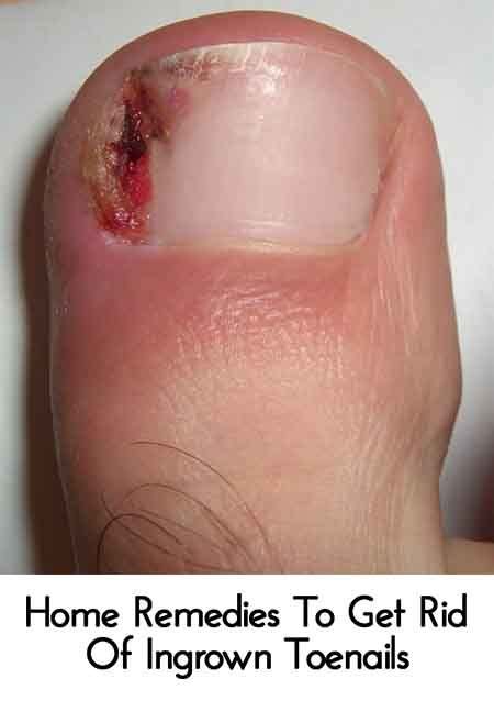Home Remedies To Get Rid Of Ingrown Toenails Lil Moo Creations