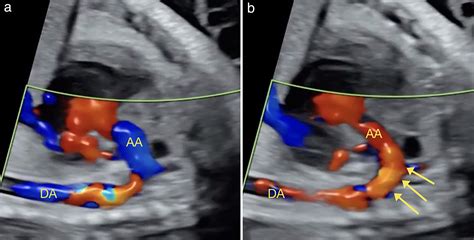 Prenatal Diagnosis Of Redundant Foramen Ovale Flap Aneurysm Prolapsing