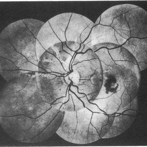 Composite Fundus Photographs Ofthe Left Eye Showing Angioid Streaks