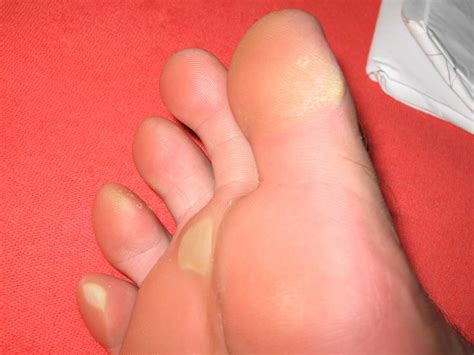 Yellow Feet 6 Potential Causes