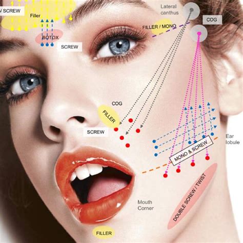 Thread lift before and after. Lift and scrub | Facial aesthetics, Thread lift, Facial ...