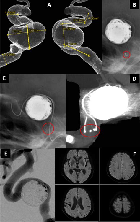 Case 1 Preoperative Three Dimensional Digital Subtraction Angiography