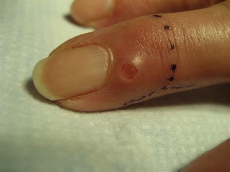 How To Drain Myxoid Cyst - Best Drain Photos Primagem.Org