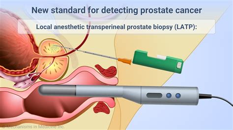 Transperineal Prostate Biopsies Under Local Anesthesia Youtube
