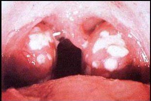 Maybe you would like to learn more about one of these? Bad Strep Throat