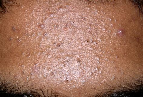 Maybe you would like to learn more about one of these? Clogged Pores on Nose, Face, Cheeks, Chin, Forehead ...