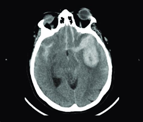Computed Tomography Ct Shows A Subarachnoid Hemorrhage And Left