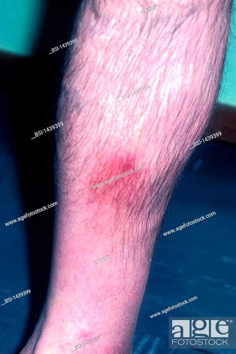 Phlebitis Stock Photo Picture And Rights Managed Image Pic Bsi