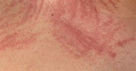 Scratch Rash Scabies Infection On The Skin Stock Image C0197928