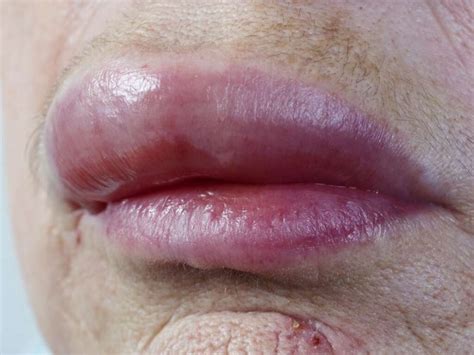Swollen Upper Lip Causes Symptoms Sudden And Top Lip Swelling