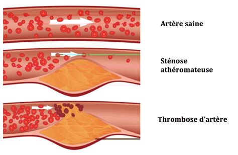 • la thrombose artérielle aigue des membres inférieures est une urgence chirurgicale absolue qui exige un diagnostic et une intervention rapide. :: chirurgie vasculaire Lyon :: Centre de chirurgie ...
