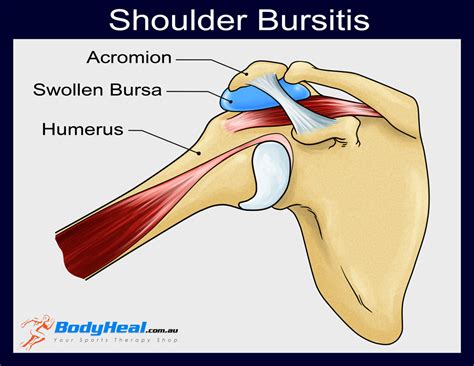 Shoulder Bursa Anatomy Anatomical Charts And Posters