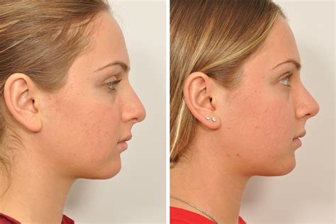 Rhinoplasty Nose Surgery Nose Job For Women In New York City David