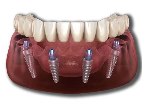 All On 4 Dental Implants in Mexico by Dr. Jose Moguel DDS