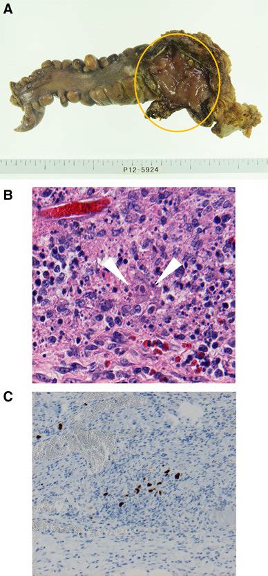 The Pathology Of Resected Sigmoid Colon With The Perforation The