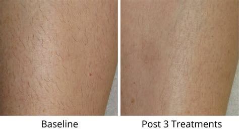 How To Prepare For Laser Hair Removal London Premier Laser