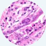Adenocarcinoma cancers being usually in one of the following organs: Mesothelioma Histology - A Study of Mesothelioma Cells