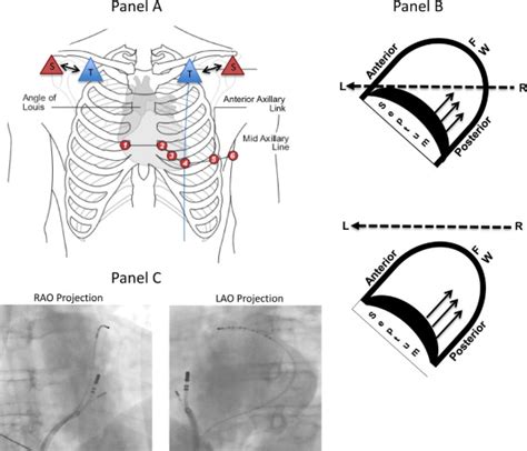Effect Of Electrocardiographic Lead Placement On Localization Of