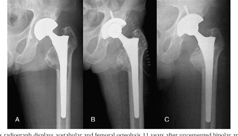 Figure 1 From Clinical Results Of Conversion Total Hip Arthroplasty