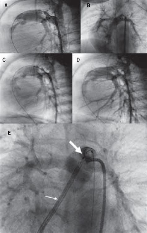 Pa Ivs With Moderate Rv Hypoplasia Ductal Stenting By Retrograde