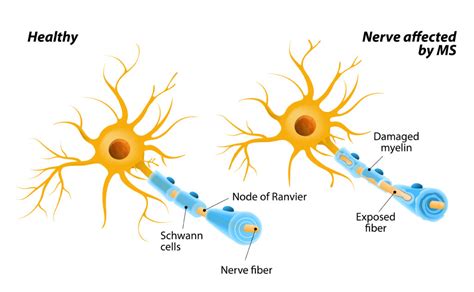 Multiple Sclerosis San Diego Biomedical Research Institutesan Diego