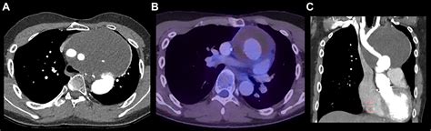 Aortic Perigraft Seroma After Total Arch Replacement—a Diagnostic
