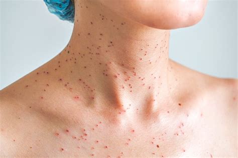 Red Spots On The Skin Possible Causes And Treatments