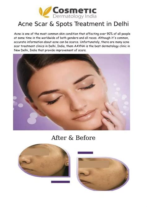 Ppt Acne Scar And Spots Treatment In Delhi Aayna Powerpoint