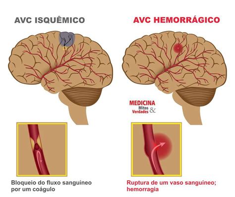 Sintomas e complicações do derrame AVC isquêmico ou hemorrágico