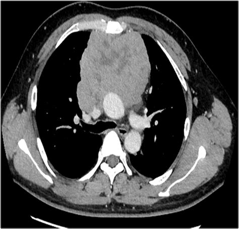 Chest Computed Tomography Showing A Large Anterior Mediastinal Tumor
