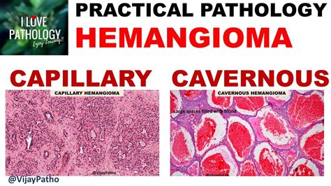 Hemangioma Capillary And Cavernous Clinical Features And Morphology Youtube