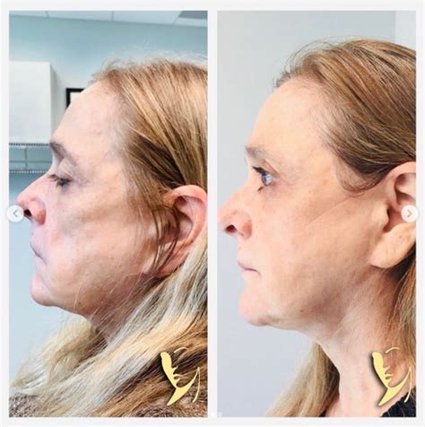 Facial Fillers Sculptra Aesthetic Jawline Contouring Robinson Fps