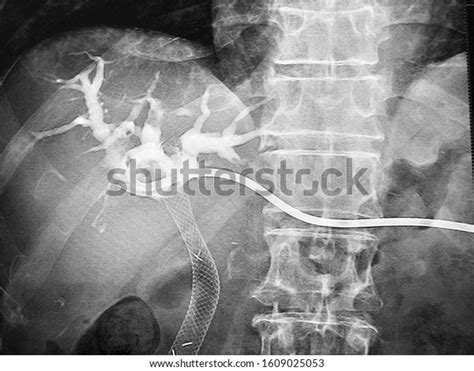 Image Percutaneous Transhepatic Biliary Drainage Ptbd Stock Photo