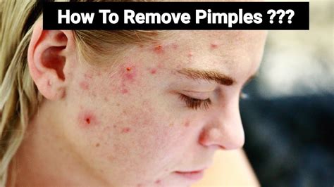 How To Remove Pimples Overnight Acne Face Pack Acnes Home Remedies