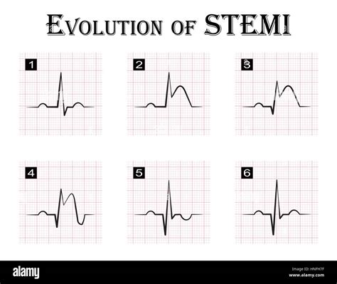 Ecg Of Evolution Step By Step Of Stemi St Elevation Myocardial
