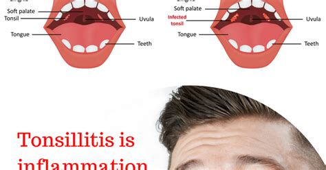 Is Tonsillitis Contagious Infographic